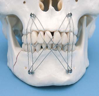 wire in an X-pattern in addition to the vertical pattern that provides maxillomandibular stabilization and