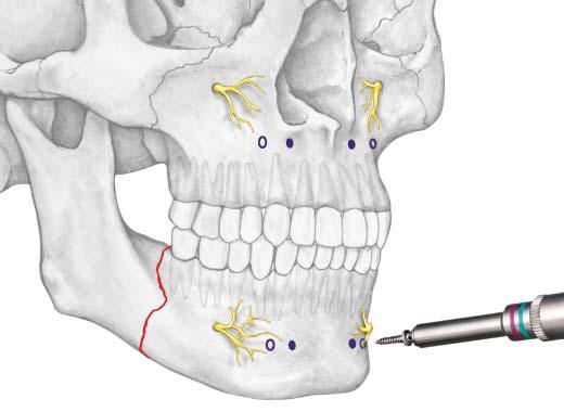 Insert Mandibular Screw 4 Insert mandibular screw Identify the important anatomic structures before inserting the mandibular screw.