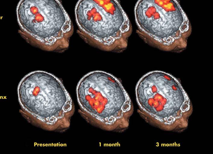 Figure 4 Graphical representation of the changes in cortical maps after a left hemisphere stroke over a period of three months. Reprinted from Hamdy S, Aziz Q, Rothwell JC, et al.