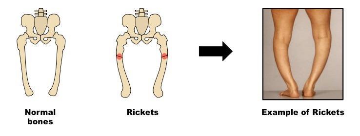Deficiency- Rickets is a disorder caused by a lack of Vitamin D, calcium and phosphate.