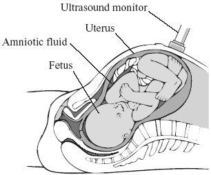 Q1. The diagram shows an ultrasound monitor being used to scan a fetus. The table shows the velocity of ultrasound waves in different tissues of the fetus.