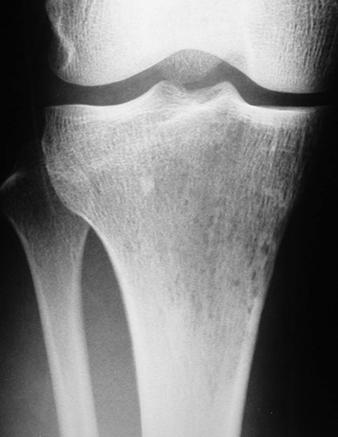 Staging one Tumors Fig. 4 24-year-old woman with telangiectatic osteosarcoma., Radiograph shows poorly defined radiolucency in proximal tibia.