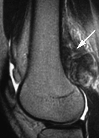 because skip lesions that are close to the primary tumor may not be easily resolved with bone scintigraphy.