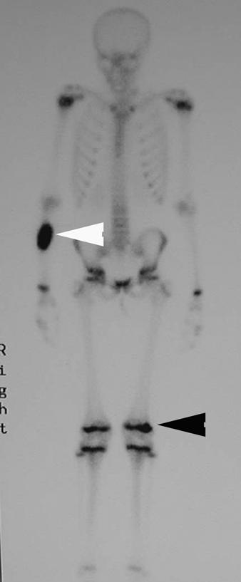 , Forearm radiograph shows osteosarcoma of ulnar diaphysis (arrowhead).