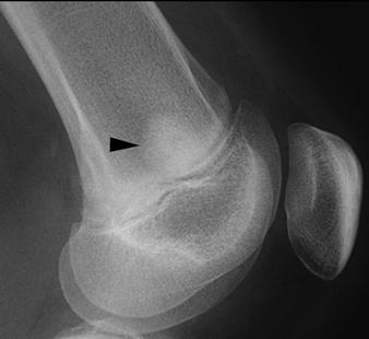 adjacent to physis. C, Knee radiograph shows histologically confirmed osteosarcoma metastasis (arrowhead) in distal femoral metaphysis.