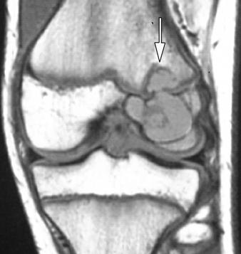 , T1-weighted coronal MR image of knee better depicts transphyseal extension of chondroblastoma (arrow). tations.