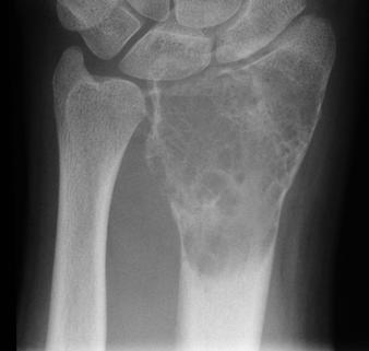 meaningful reports. Fig. 12 50-year-old man with giant cell tumor of bone., Wrist radiograph shows slightly expansile radiolucent lesion of distal radius extending to articular surface.