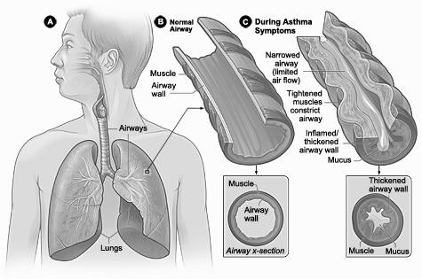 Asthma Characterized by dyspnea, wheezing, and chest tightness Active inflammation of the airways precedes bronchospasms Airway inflammation is an immune response caused by release of IL-4 and IL-5,