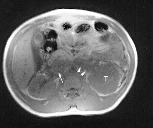 Renal cell carcinoma of left kidney was impressed preoperatively by MR imaging study. The patient underwent the procedure of left radical nephrectomy, IVC and right atrial tumor thrombectomy.