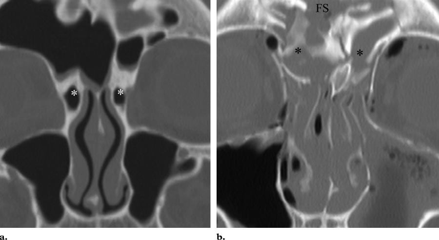 RG f Volume 26 Number 3 Hopper et al 787 Figure 5. Nasofrontal ducts. (a) Coronal nonenhanced CT image shows the normal anatomy in the region of the nasofrontal ducts (*).