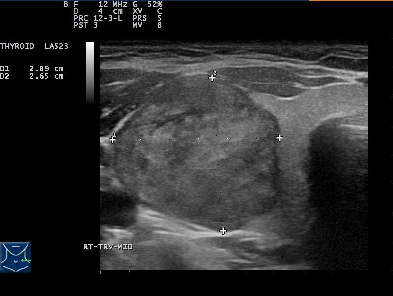 Extensive abutment of thyroid capsule suggests a high risk for ETE Lee CY, Kim SJ, Ko Kr, et al.