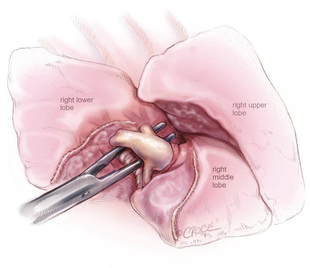 lobectomy and en bloc removal of Station 5 and Station 6 lymph nodes Figure 8 VATS right