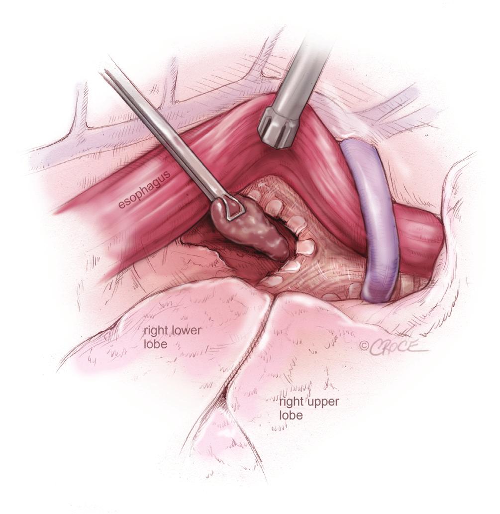 lymph node dissection: subcarinal lymph node dissection from the right side, by retracting