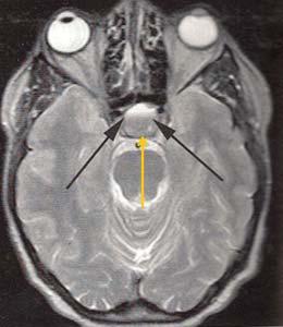 Companion Patient #2 Pituitary Apoplexy Pituitary apoplexy is a complication of macroadenomas that occurs when they grow too large for their blood supply and infarct, or spontaneously bleeds This is