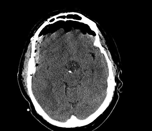 Companion Patient #4 Craniopharyngioma Slow growing tumor that arises from epithelium derived