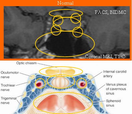 Sellar Anatomy (Coronal) Normal PACS, BIDMC 1. Optic Chiasm 2. Pituitary Gland 3. Internal carotids 4.