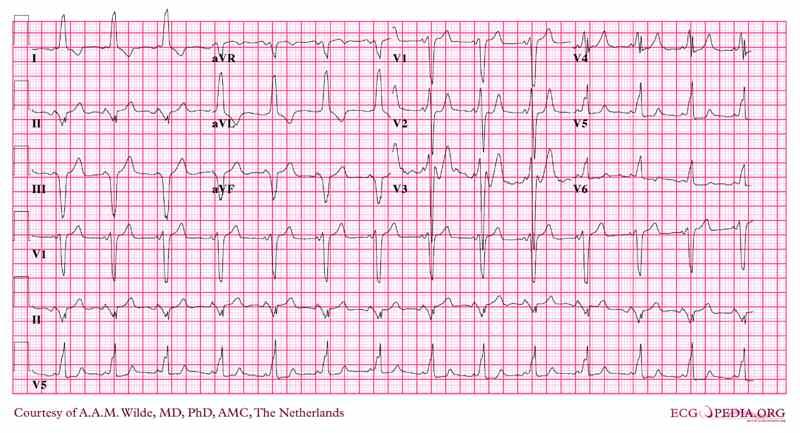 ECG case study 5 17 year old female. OP clinic.