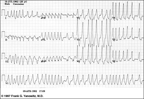 ECG Case study 2 34 Year Old Male, Sudden onset palps.
