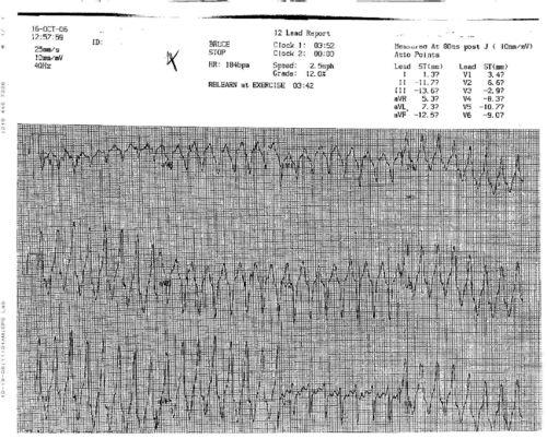 ECG workshop and Case study 4 24 Year old male, palps on