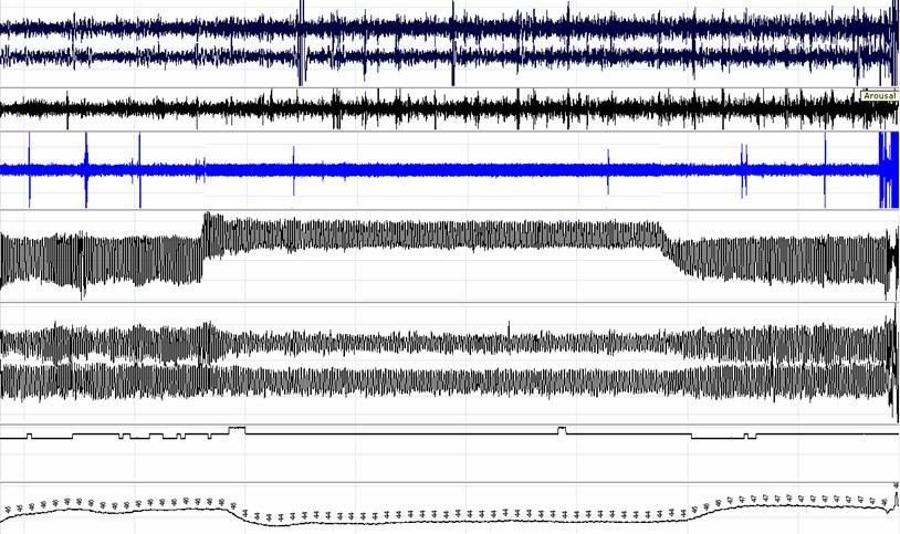 Panel A Arousals EOG EEG EMG Effect on Ventilation OFF (SNORING) TNI ON OFF (SNORING) Flow (L/min) 0 RC Abd SaO 2 (%) tc-co 2 (mmhg) 100 90 50 40 Panel B