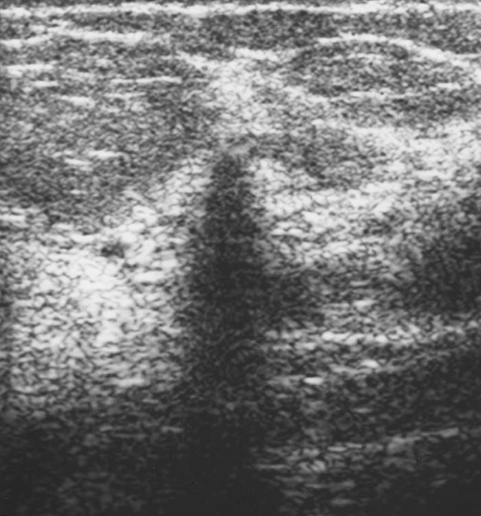 Sonographic Imaging of the reast Downloaded from www.ajronline.org by 80.243.135.192 on 02/26/18 from IP address 80.243.135.192. Copyright RRS. For personal use only; all rights reserved Fig. 4.