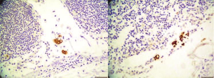 A B 25 µm 25 µm FIGURE 1: Lymph node sections from a patient with gastric cardia adenocarcinoma showing small clusters of cells immunohistochemically positive for (A) cytokeratin 19 or (B) CD44