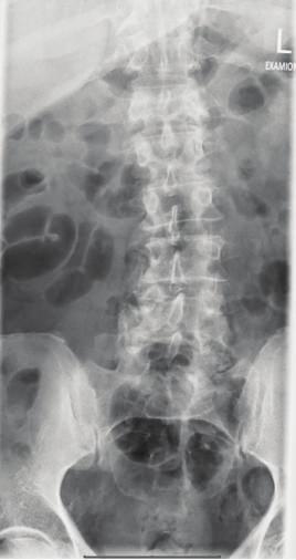 2 Case Reports in Orthopedics 2. X-Rays See Figures 1, 2, 3, 4, 5, and 6. 3. Discussion Figure 1: Lumbar spine radiographs on admission showed degenerative changes.