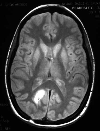Q14. The arrow indicates an abnormality that has been detected in one hemisphere of the brain.