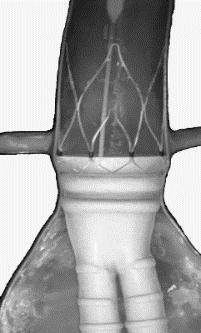 Figure 2. TriVascular Aortic Body Stent Graft in aorta 1.