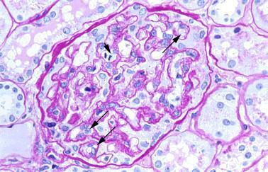 QUESTION 53 Endothelial cell pathology on renal biopsy is most characteristic of which one of the following diagnoses? A. Pre-eclampsia B. Haemolytic uraemic syndrome C. Lupus nephritis D.