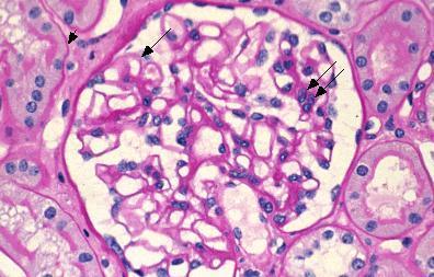 Light micrograph in preeclampsia showing glomerular endotheliosis.