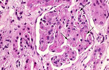 Light micrograph showing multiple intracapillary glomerular thrombi (arrows) typical of a thrombotic microangiopathy as can be seen in any of the forms of the hemolytic-uremic syndrome.