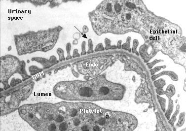 Ep: epithelial cell; GBM: glomerular basement membrane. Courtesy of Helmut Rennke, MD.