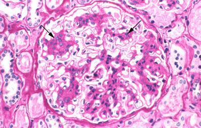 Light micrograph of a mesangial glomerulonephritis showing segmental areas of increased mesangial matrix and cellularity (arrows).