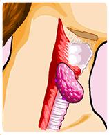 IODINE: Goiter Lack of iodine can cause your thyroid to enlarge and