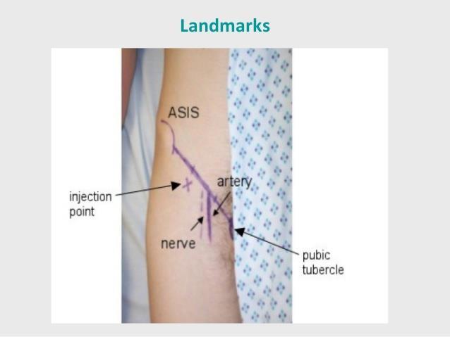 Figure 6 1 Landmarks projected onto the skin. Anterior superior iliac spine (ASIS), pubic tubercle, with the adjoining line divided into thirds.