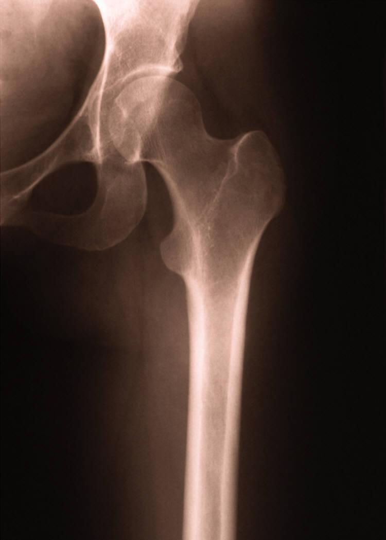 Hip Fractures have Serious Consequences Usually requires surgery 1 in 5 need a skilled nursing facility