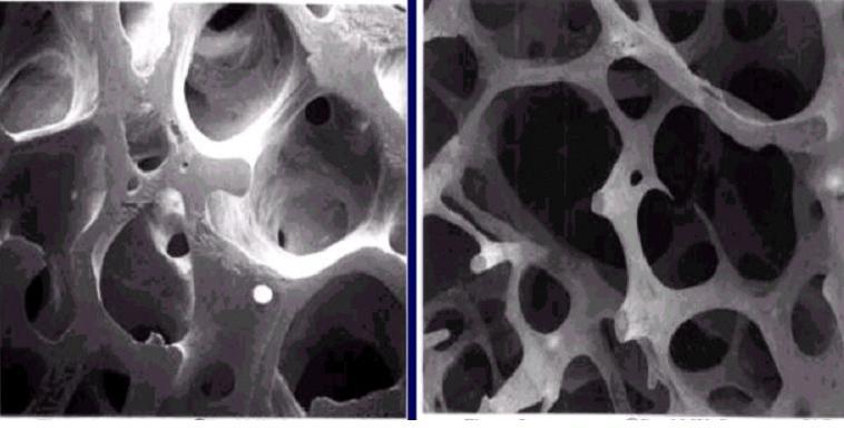 Osteoporosis is a Silent Disease You can