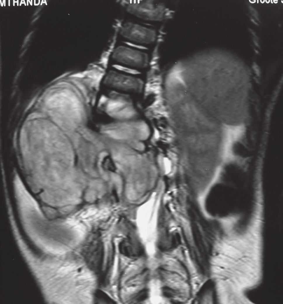 4 6 Vertebral with intraspinal extradural 6 4 a b Fig. 3. A one-and-a-half-year-old boy with infantile fibromatosis.