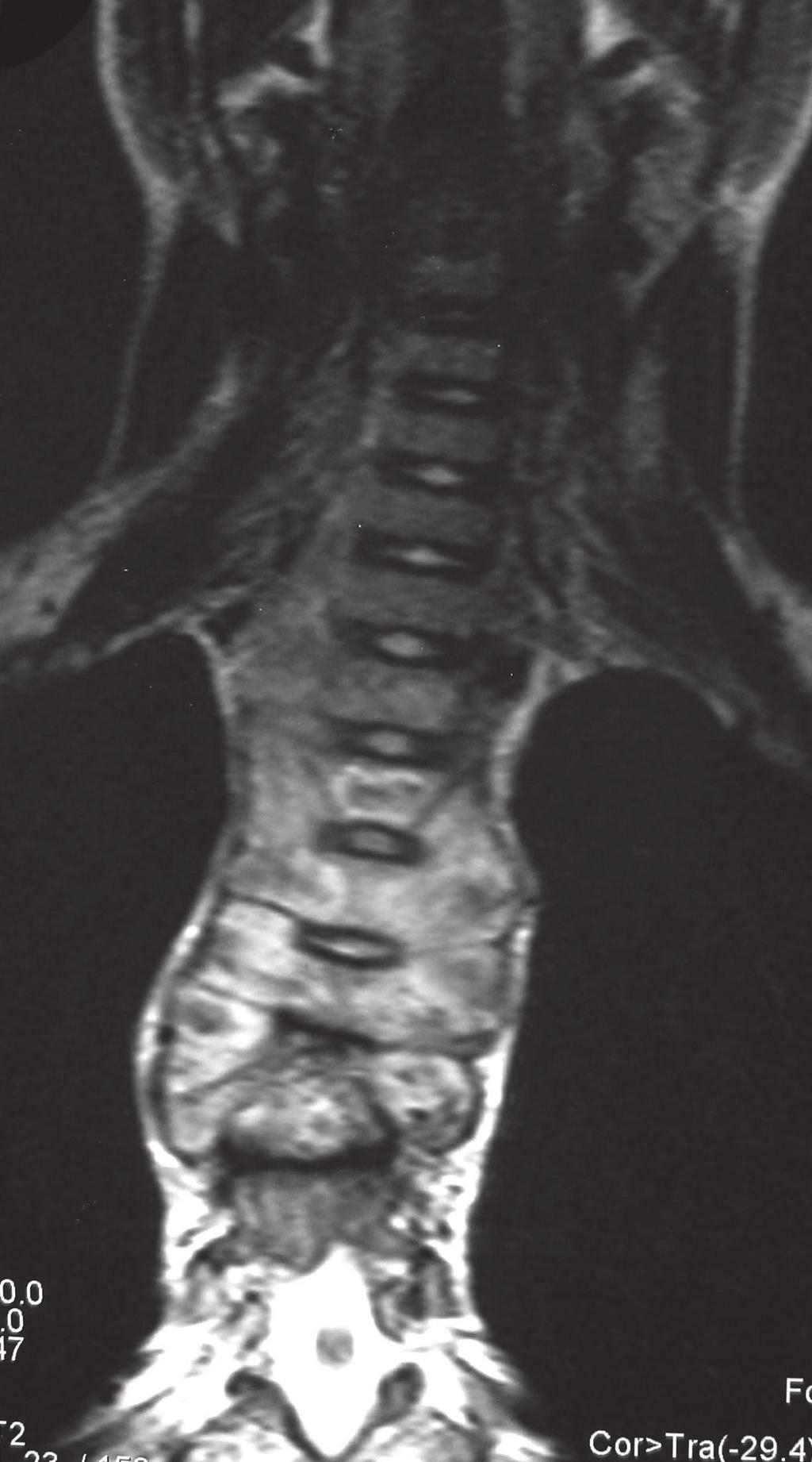 There is a predominantly anterior ring-enhancing soft-tissue mass but the smaller posterior extradural component causes spinal cord compression.
