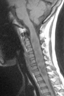 Spinal cord astrocytoma Intramedullary astrocytoma of