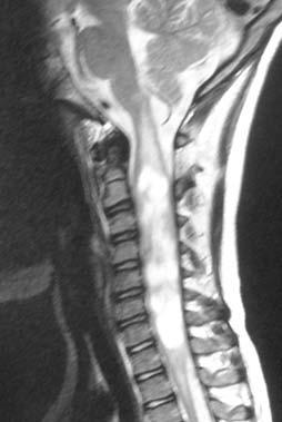 (Left) T1- weighted MRI showing enlarged cervical cord