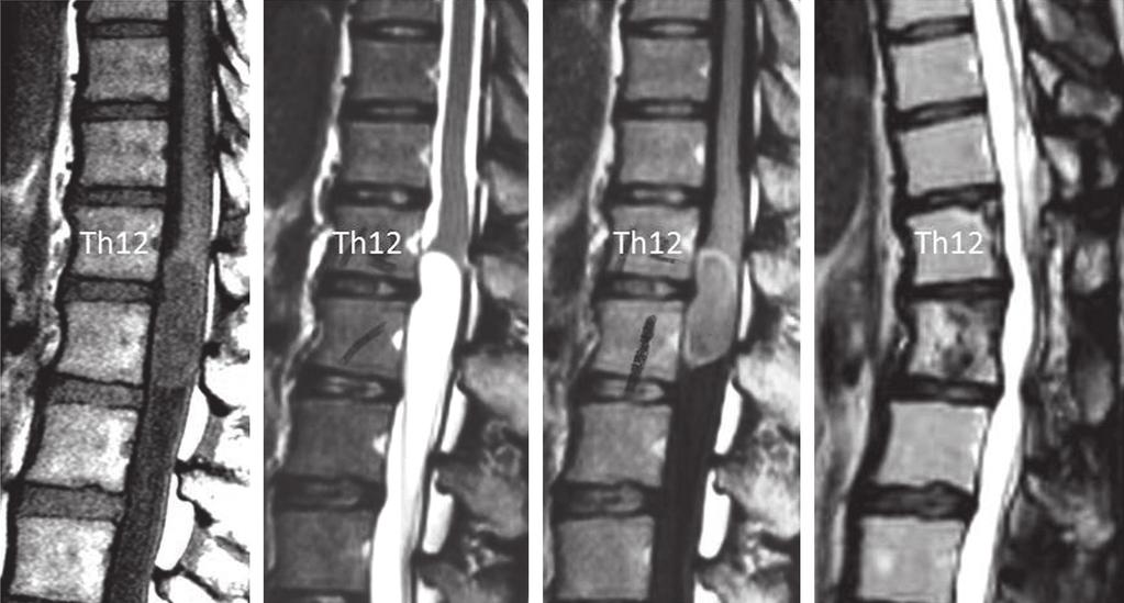 Asian Spine Journal Surgical outcomes of high-grade intramedullary tumor 939 Fig. 4. Effect of radiation cordotomy on patient survival.