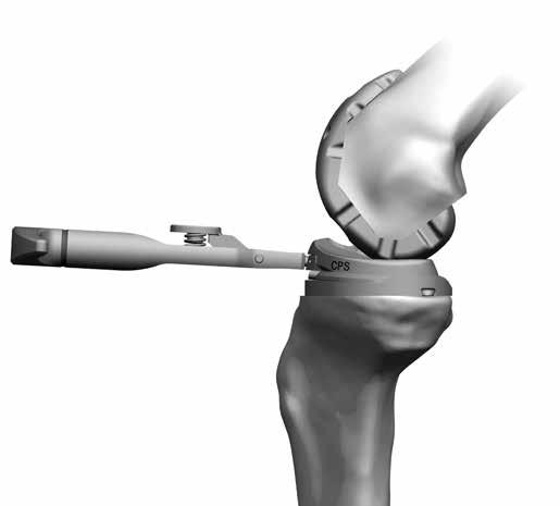 9 Persona Constrained Posterior Stabilized Surgical Technique Lift Figure 11 CPS TASP Removal Disengage the provisional lockdown screw by rotating the 3.