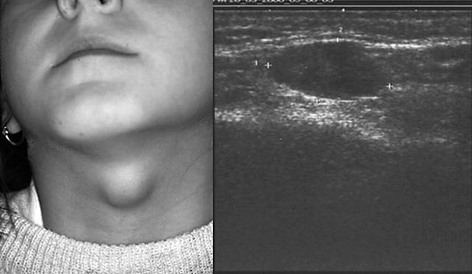 Slika 1. Medijalna cista vrata djevojčice, UTZ prikazom anehogena ovalna tvorba. a može razlučiti da li se radi o benignoj ili malignoj leziji.