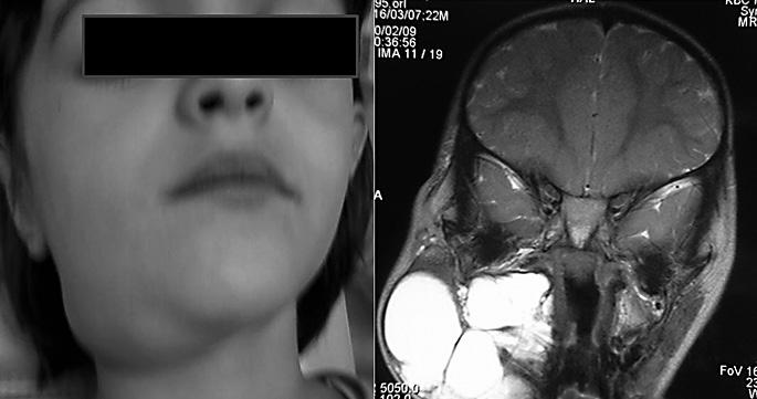 Slika 4. Tvorba vrata desno submandibularno djevojčice, MR glave i vrata sa prikazom tumorske tvorbe, limfangiom. tilokularne cistične tvorbe.