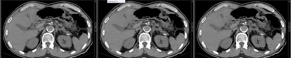 Kidney stone CT: Seen at Lower Dose FBP