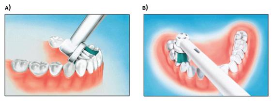 Figure 8: Prophy angle with a round rotating rubber cup used during professional cleaning Figure 10: The Oral-B power toothbrush allows users to effortlessly reach the A) anterior lingual and B)