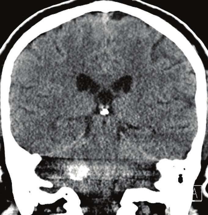 Figure 2: Axial and coronal CT angiography (CTA) of the head in the arterial phase demonstrates unchanged hemorrhage in the region inferior right cerebellar peduncle, likely intraparenchymal, with