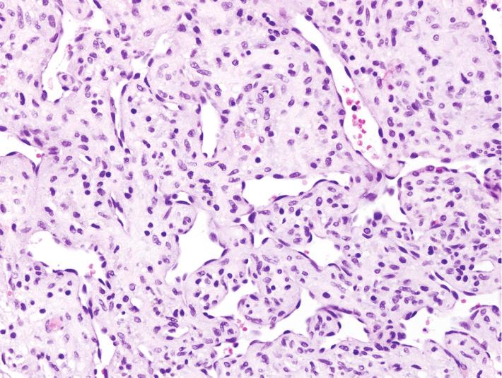 (c)-(d) Immunohistochemistry, the tumor cells arepositive for CD31 ((c), 400) as well as negative for inhibin ((d) left, 400) and EMA ((d) right,